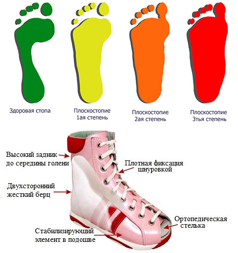 особенности ортопедической обуви